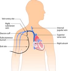 Central venous catheter - Wikipedia