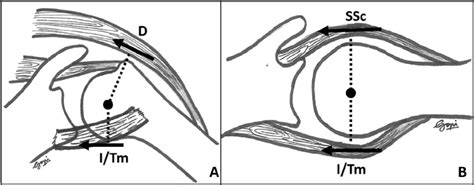 A Coronal Force Couple B Transverse Force Couple D 1⁄4 Deltoid