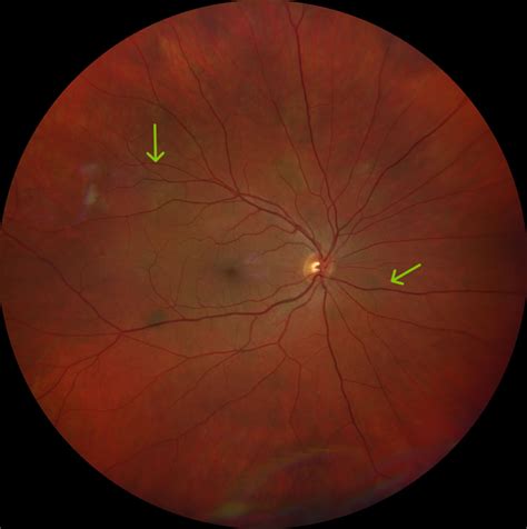 Neurofibromatosis with multiple bilateral choroidal nevi and literature