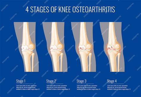 premium vector knee joint osteoarthritis stages infographics