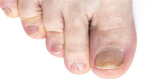 Get Rid Of Yellow Toenails For Good With These 4 Natural Remedies