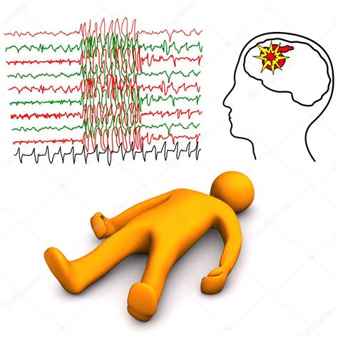 apoplectic  epileptic stroke stock photo  limbi