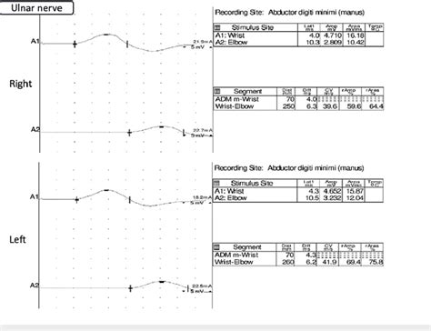 Nerve conduction velocity tests of ulnar nerves revealing possible ...