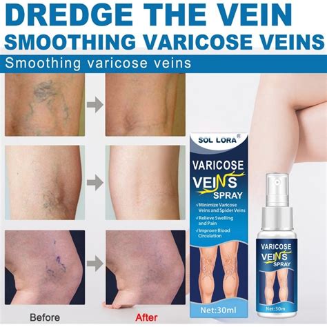 Jual Varicose Vein Spray 30ml Herbal Pain Relief Effective Remover Legs