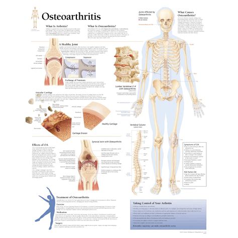 Scientific Publishing Osteoarthritis Education Chart