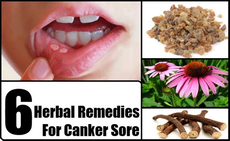 Top 6 Herbal Remedies For Canker Sore - How To Treat Canker Sore With ...
