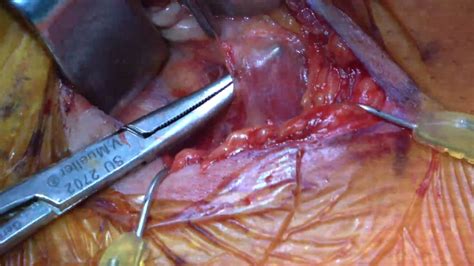 Mount Sinai Otolaryngology Surgical Series Obstructive Sleep Apnea