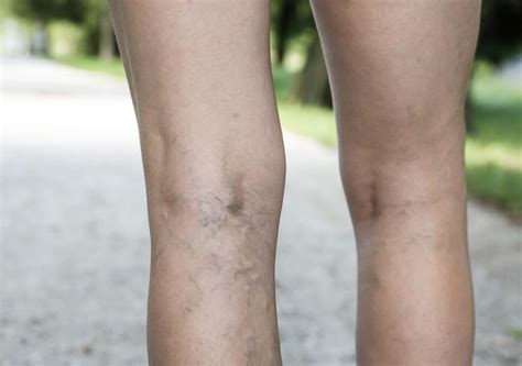 thrombosis   thrombosis