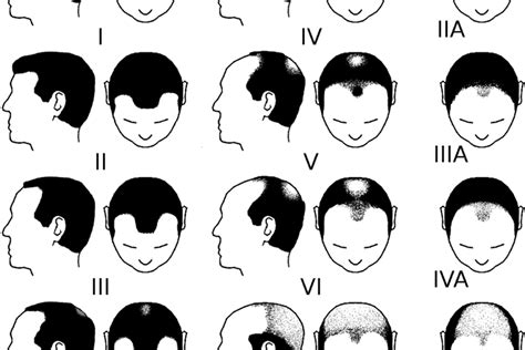 The Norwood Scale The 7 Stages Of Male Pattern Baldness Fue Clinics