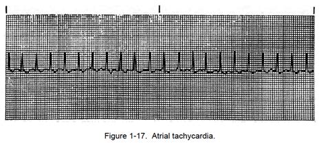 atrial rhythms cardiac rhythm interpretation