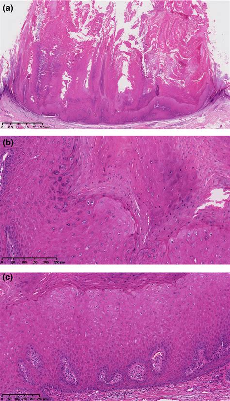 Verruca Plantaris Histology