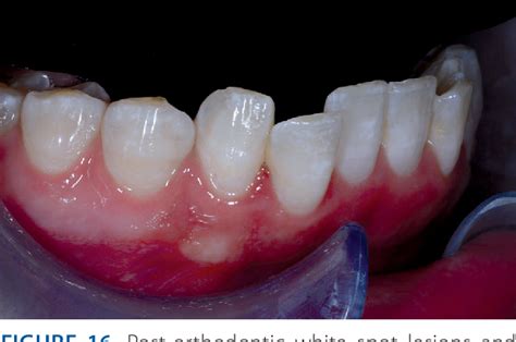 Figure 16 From Treatment Of Post Orthodontic White Spot Lesions By