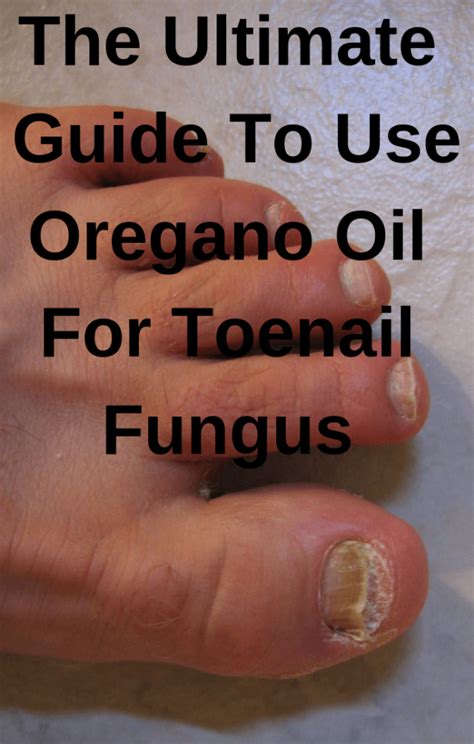 Best Oregano Oil For Toenail Fungus In 2021 And Beyond Toenail Fungus Nail Health Toe Nails