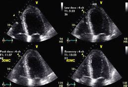 Dobutamine Stress Test - Echocardiogram Test | SA Heart