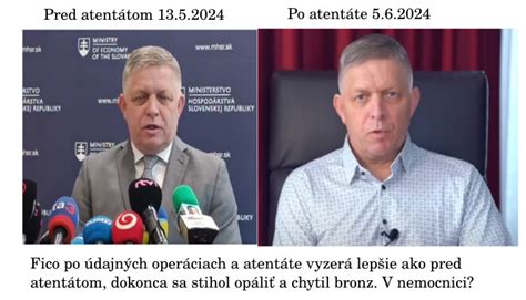 Fico Po Atentáte Vyzerá Lepšie A Opáleny Ako Pred Atentátom Bol