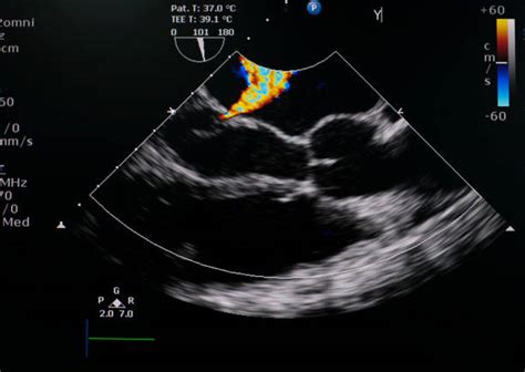 doppler echocardiogram stock  pictures royalty