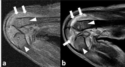 (A and B): Coronal short tau inversion recovery (STIR) and T2W and ...