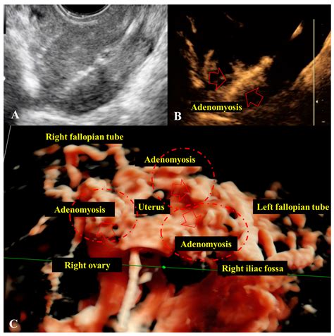 adenomyosis modern techniques  ultrasound  histo pathological