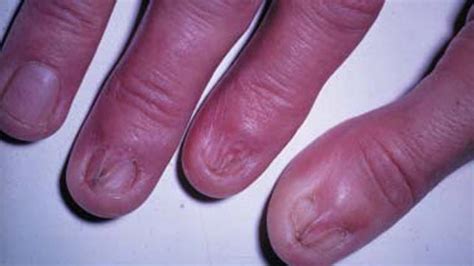 Lichen Planus: Symptoms, Diagnosis, Treatment, and Risks