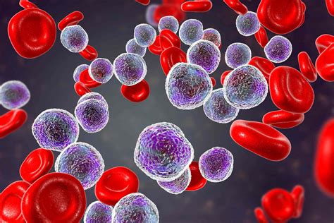 A Leucemia É Uma Doença Neoplasica Do Sistema Hematopoiético - O que é leucemia? Entenda a doença