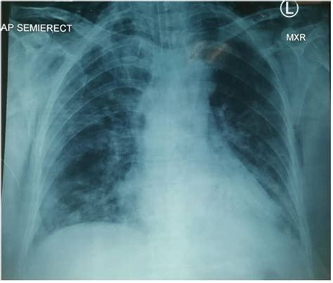 Subcutaneous Emphysema