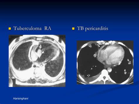 Ppt Tuberculosis What Is Essential To Know Powerpoint Presentation Id 3413206