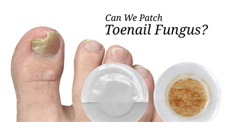 Approaching Toenail Fungus Using Lifewave Patches - Patching Protocol