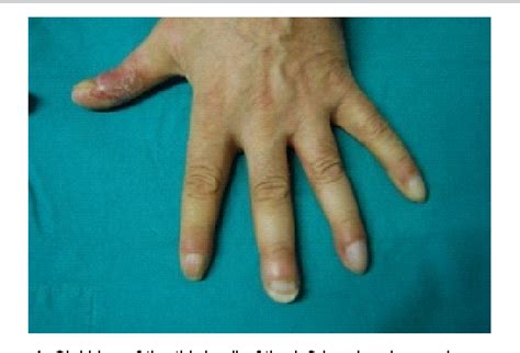 Figure 1 from Clubbing/Pseudoclubbing only in Fingernails Previously ...