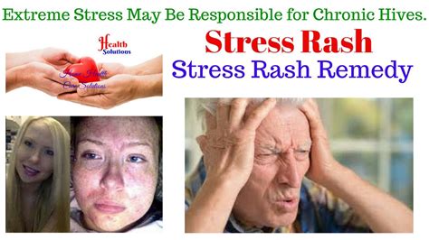 Stress Rash On Hands