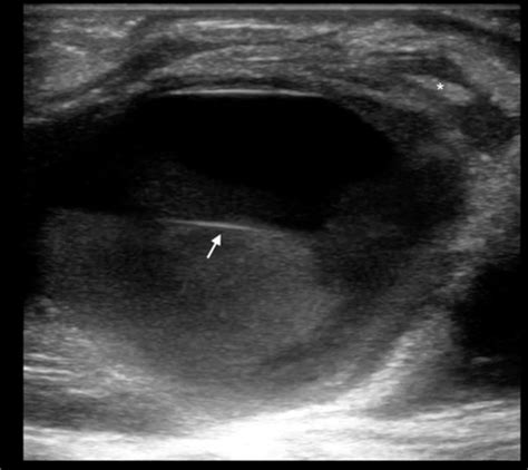 Emergency Point Of Care Ultrasound Diagnosis Of A Femoral Artery