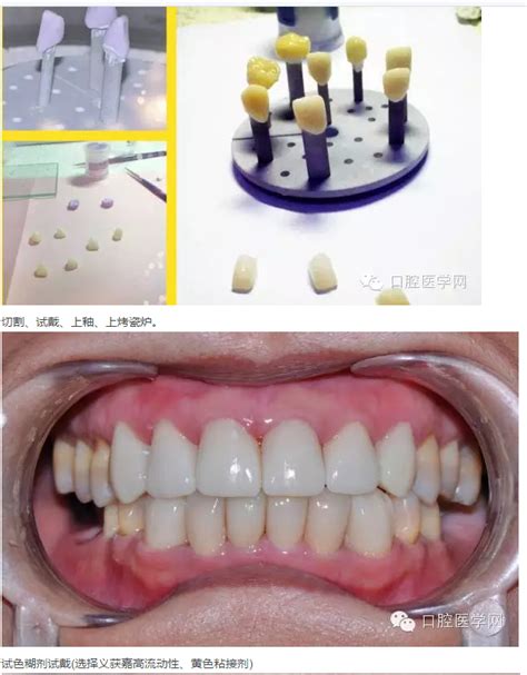 瓷睿刻前牙美学修复1例美学修复陕西嘉友科贸有限公司