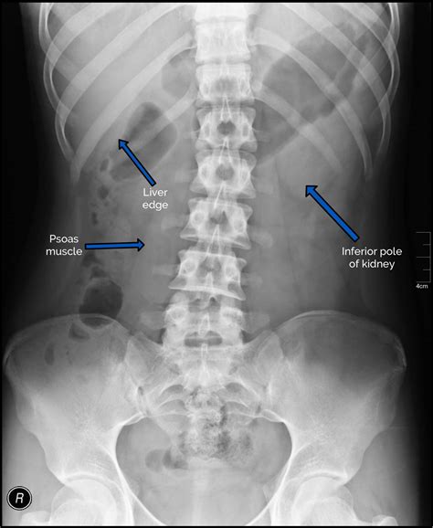 Abdominal X-ray Interpretation (AXR) | Radiology | OSCE | Geeky Medics