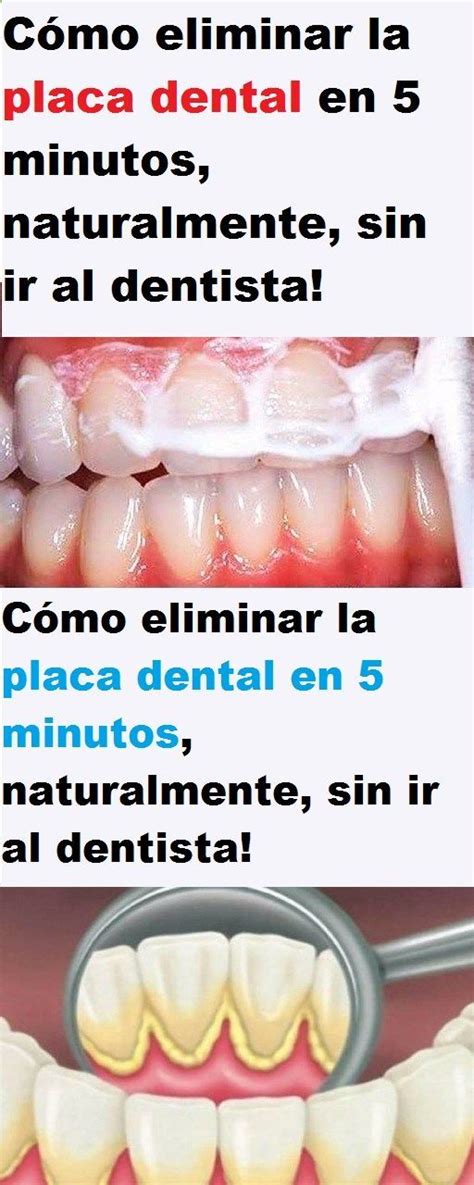 Cómo eliminar la placa dental en 5 minutos naturalmente sin ir al