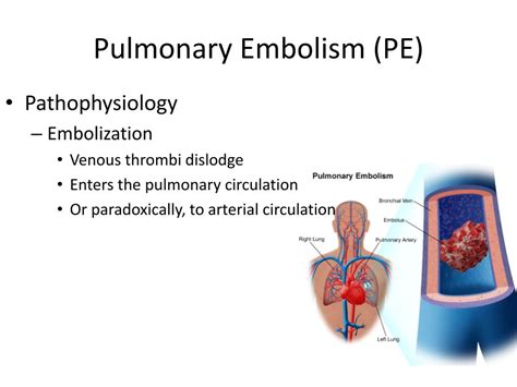pulmonary embolism powerpoint    id
