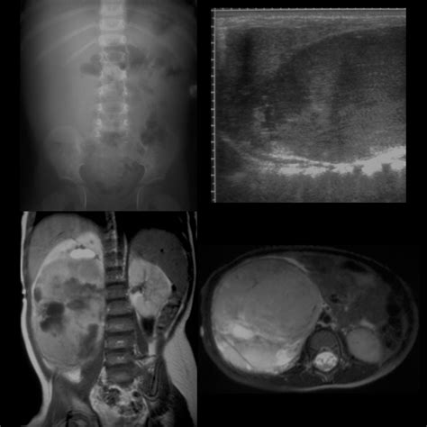 Wilms Tumor Pediatric Radiology Reference Article Pediatric Imaging