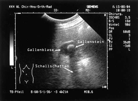Cholelithiasis Gallensteinleiden Medizin Lexikon Lecturio