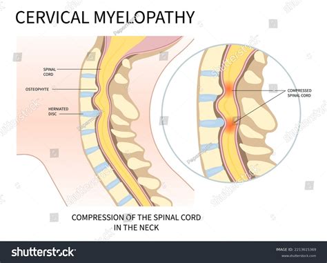 Cervical Nerve Root Compression That Cause Stock Vector (Royalty Free ...