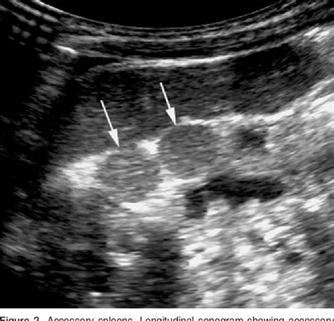 Table 2 From A Pictorial Review Of Splenic Pathology At Ultrasound