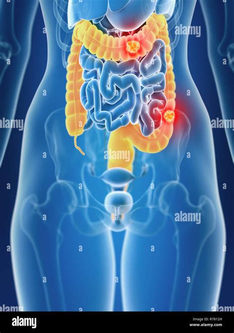 3d rendered illustration of female colon cancer Stock Photo - Alamy