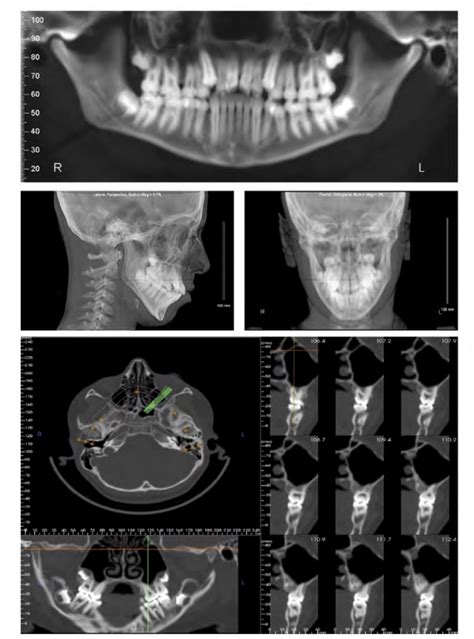 Cbct Data Can Be Easily Reconstructed Into Traditional Panoramic