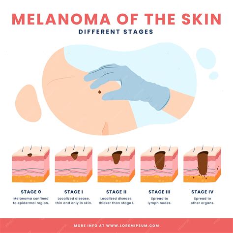 Free Vector | Hand drawn flat design melanoma infographic