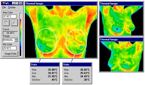 Mammography Vs. Thermography – Las Vegas Thermography