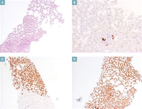 Diagnosis Of Well Differentiated Hepatocellular Lesions In Healthy