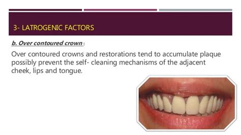 Local Predisposing Factor Of Periodontal Disease