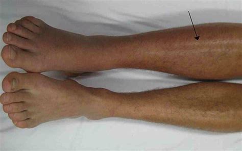 calf tears swelling  dvt runningphysio