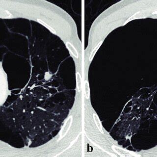 Axial Images Of Computed Tomography Ct Scans Of The Chest