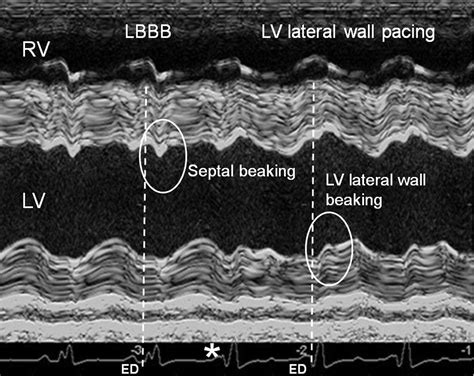 Mechanisms Of Abnormal Systolic Motion Of The Interventricular Septum