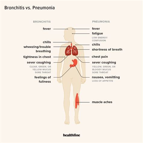 Bronchitis vs. Pneumonia: How to Tell