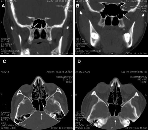 Greater And Lesser Wing Of Sphenoid Ct - slidesharetrick