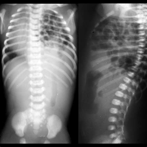 Congenital Diaphragmatic Hernia | Pediatric Radiology Reference Article